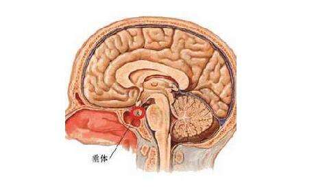 脑垂体瘤的常见症状有哪些?