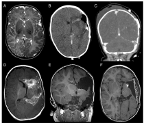 恶性脑胶质瘤的4种类型