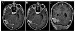 恶性脑胶质瘤的4个级别介绍
