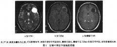 神经节细胞胶质瘤患者的MRI是怎么表现的？