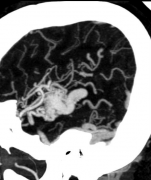 <b>【脑血管瘤】脑血管畸形影像诊断是否有必要？</b>