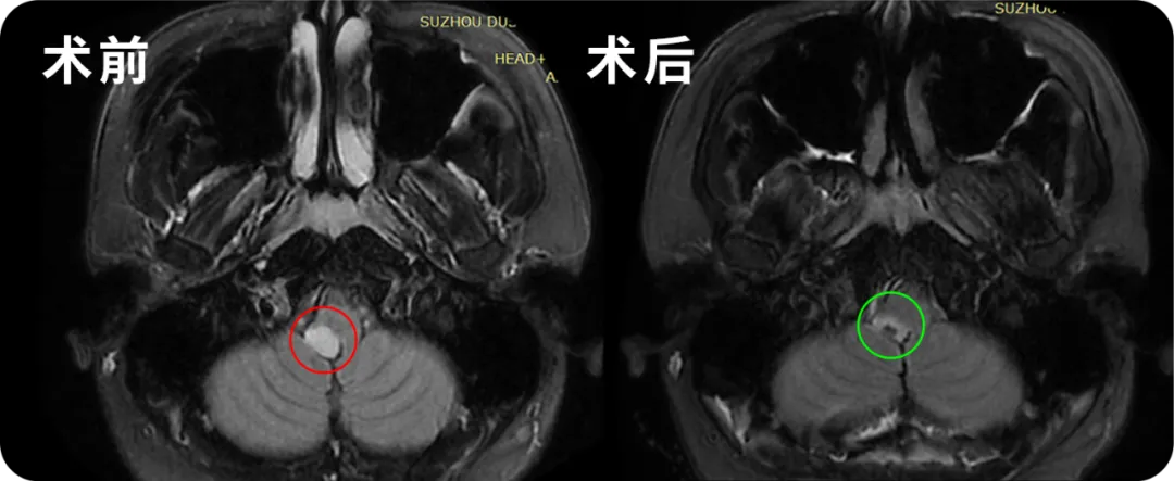 脑干延髓胶质瘤案例：轻则残、重则亡？脑干延髓手术出路在何方？