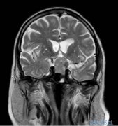【脑瘤案例】85岁垂体瘤经典案例分析