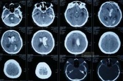 脑动脉瘤到底如何治疗好？