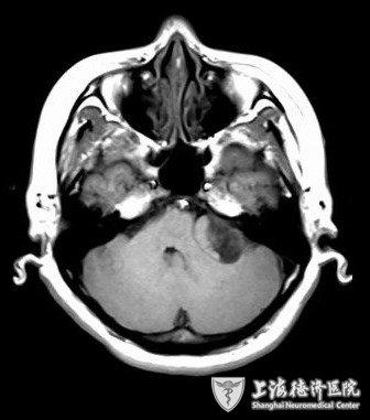 【脑干胶质瘤】脑干胶质瘤发病部位的症状