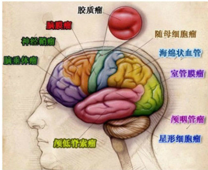 脑膜瘤示意图图片